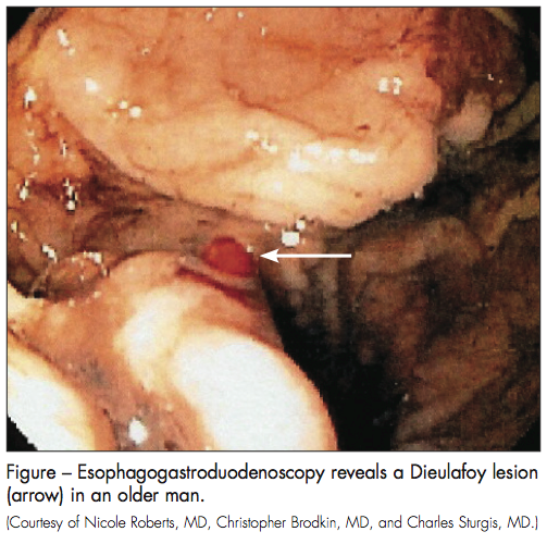 dieulafoy lesion