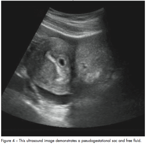 double decidual ring