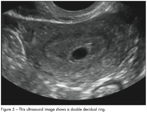 double decidual ring
