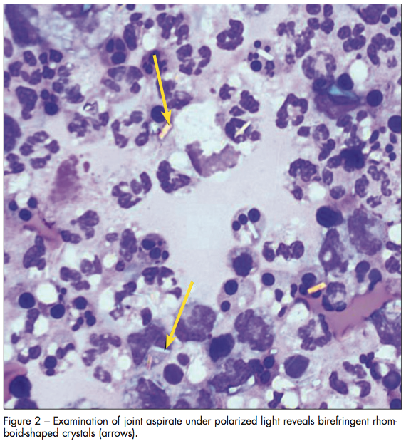 birefringent crystals
