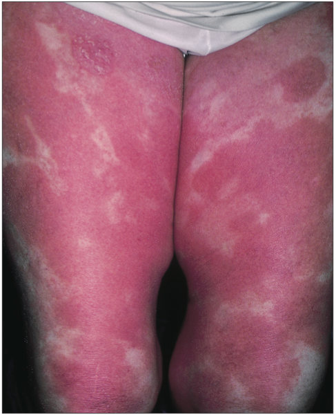 psoriasis