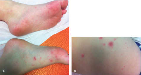 atypical rash