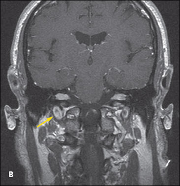 cranial nerves VII and VIII