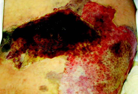 Necrotizing fasciitis