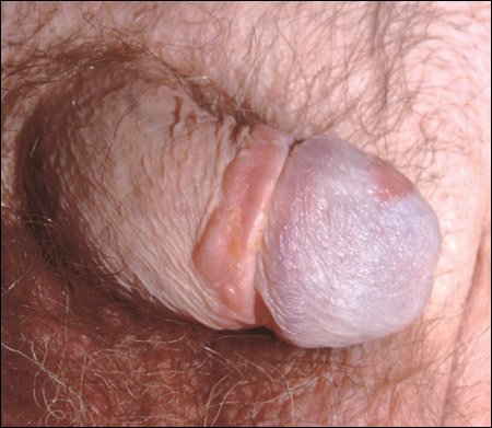 SQUAMOUS CELL CARCINOMA IN SITU OF THE PENIS