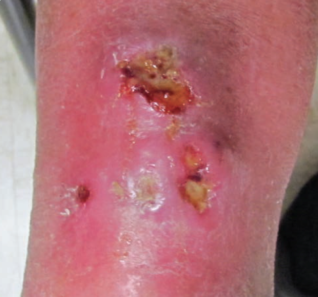 Pyoderma Gangrenosum