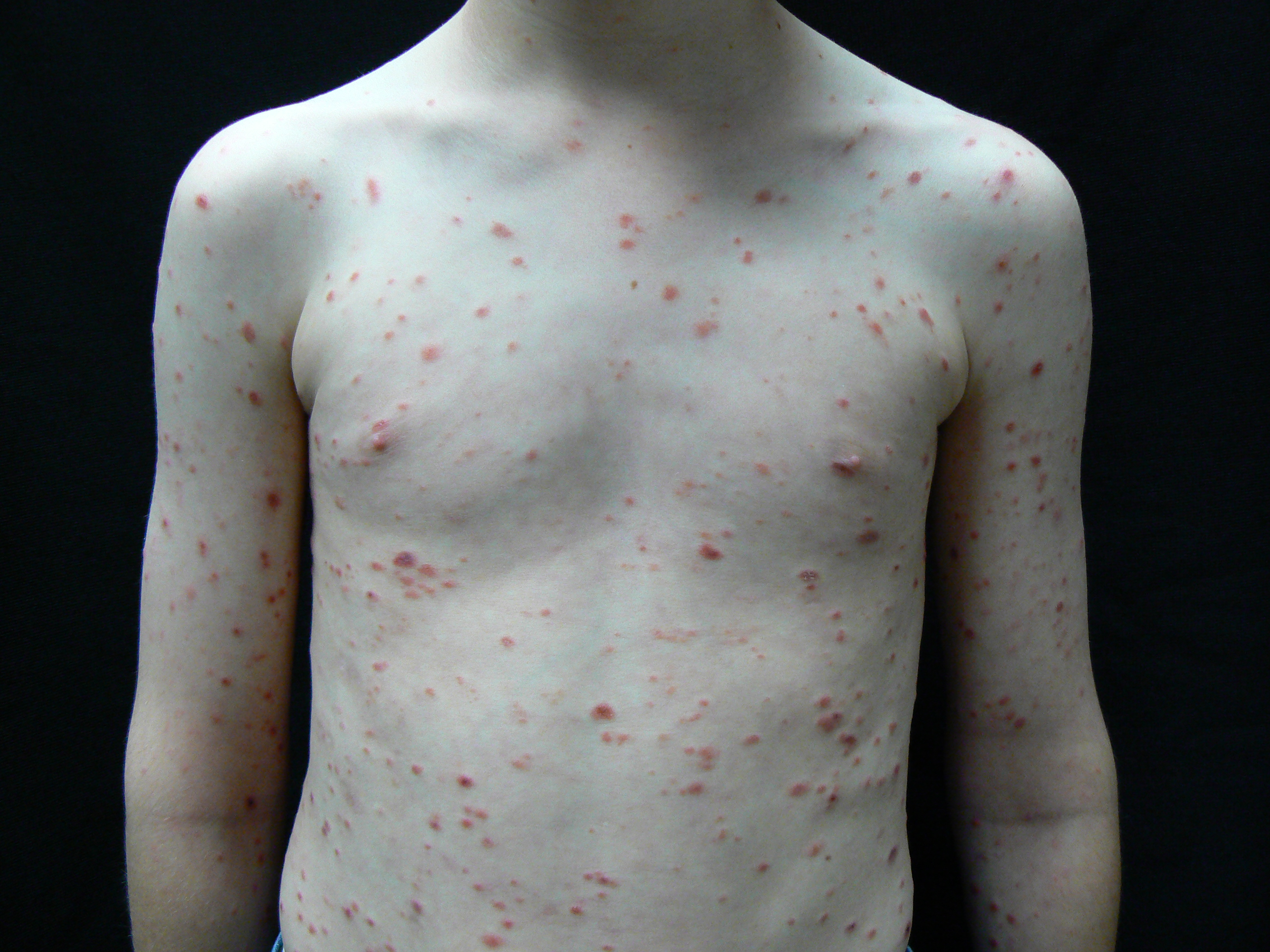 Diffuse Red Eruptions in a Young Boy | Consultant360