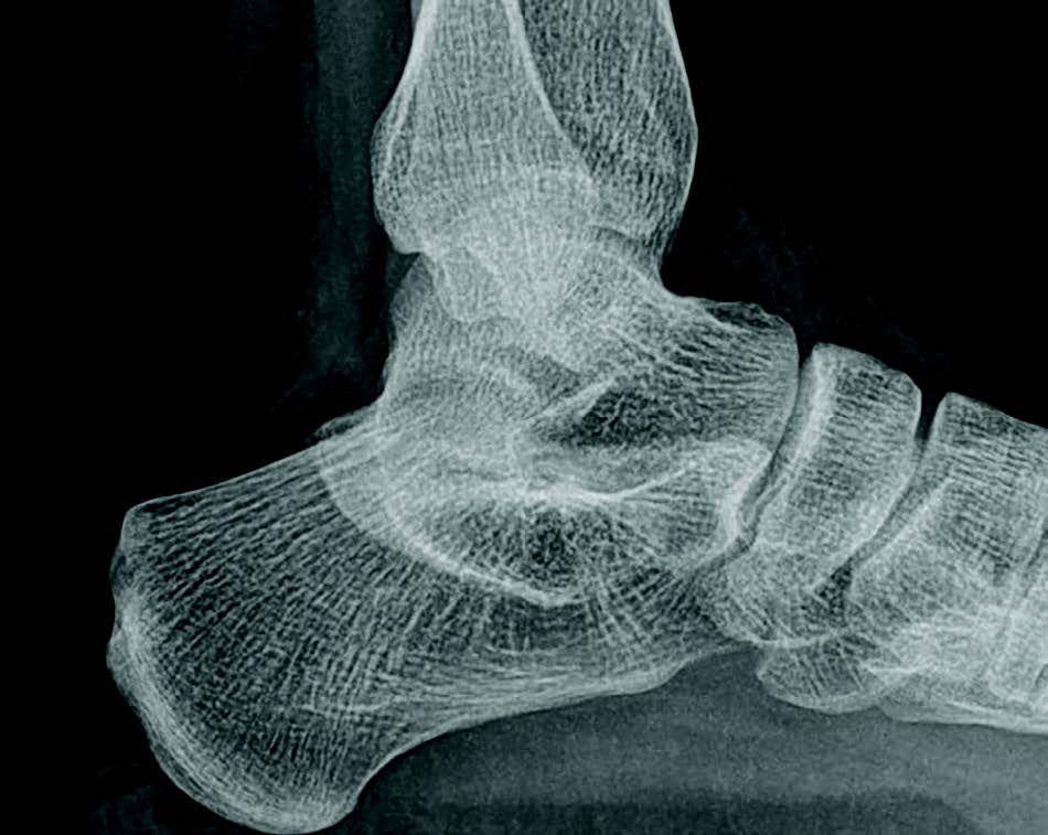 Emerging Insights In The Surgical Management Of Talocalcaneal