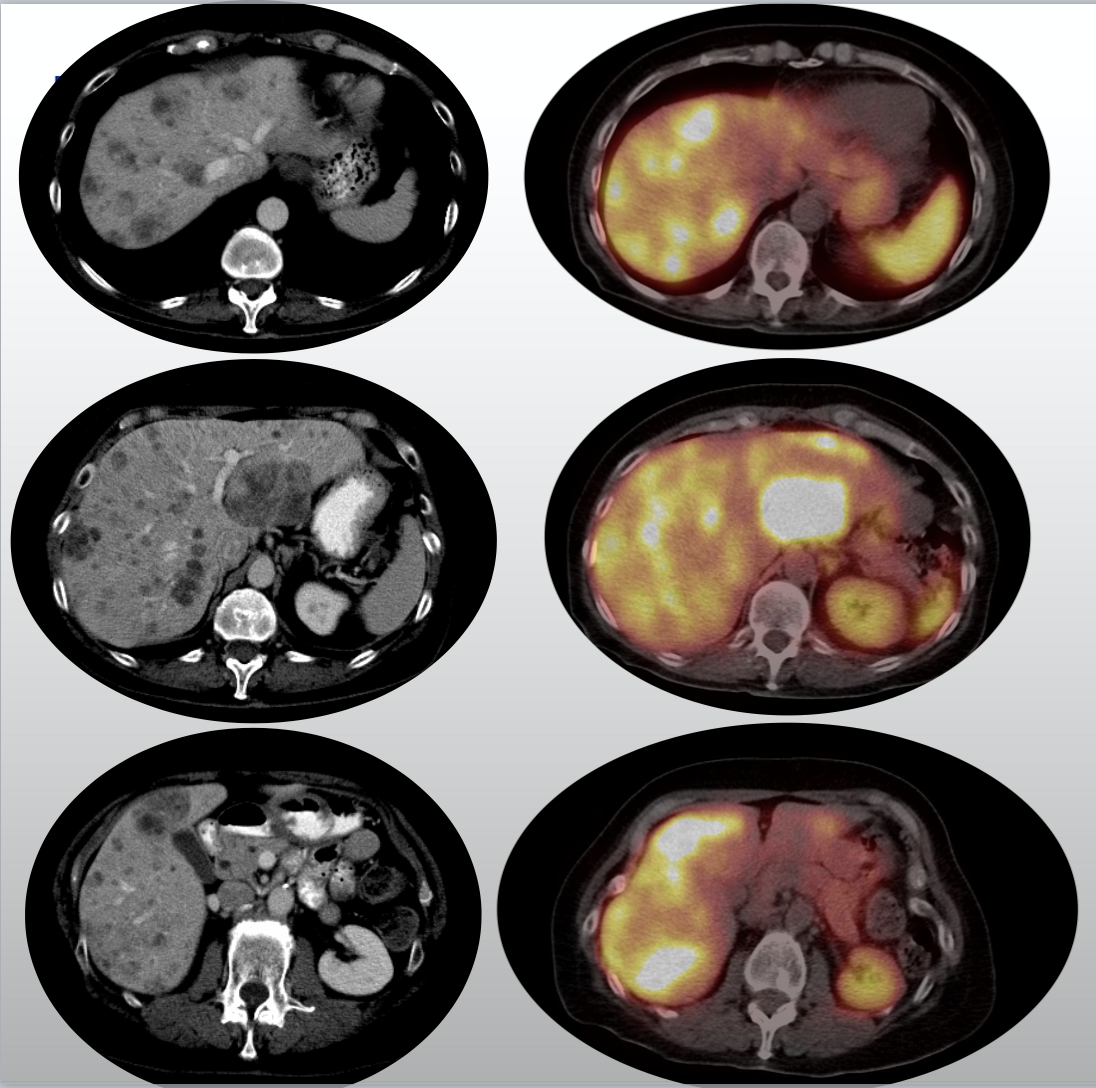 Bland Hepatic Embolization of a WellDifferentiated Neuroendocrine