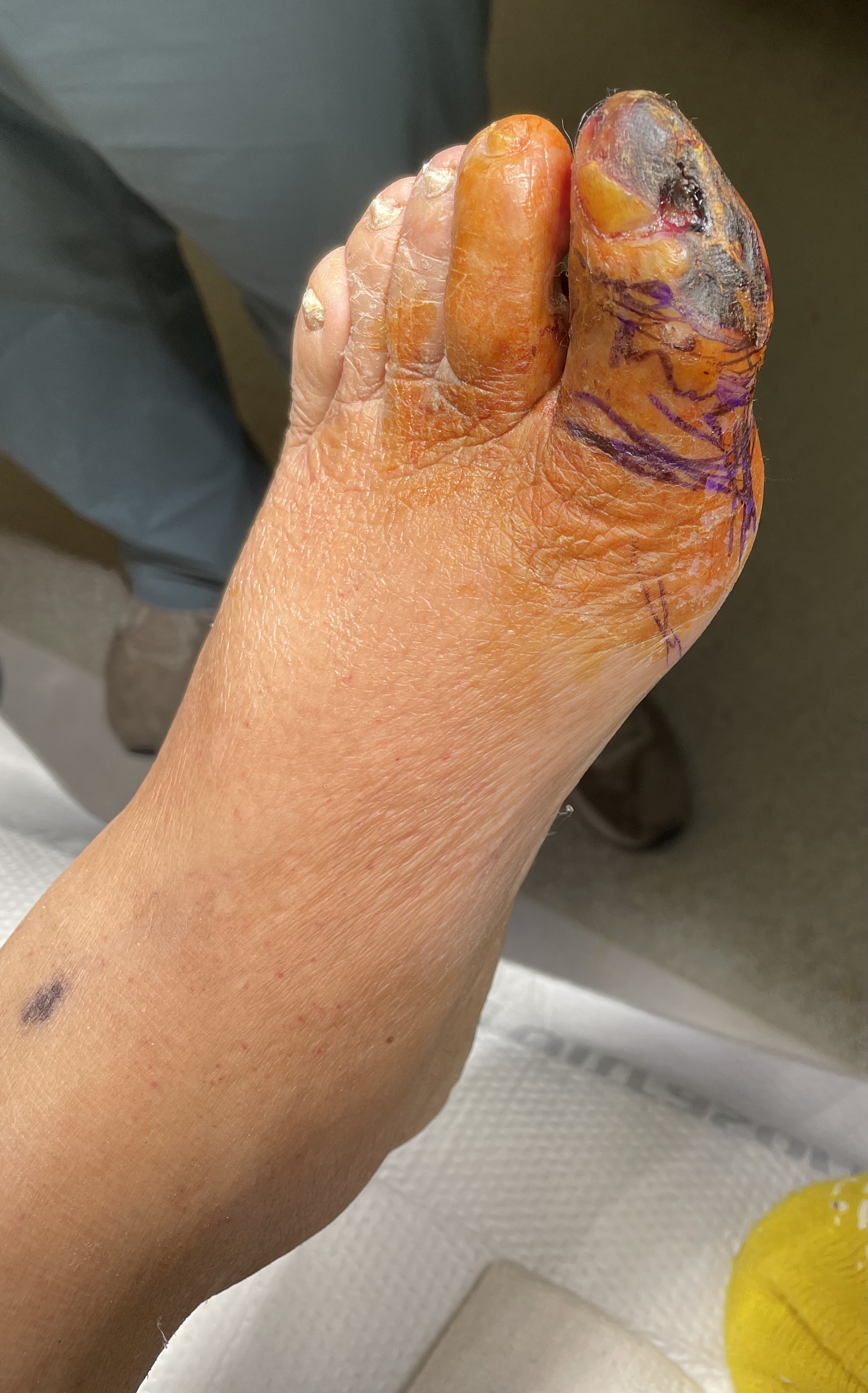 Lower Extremity Perfusion Assessment Today S Wound Clinic