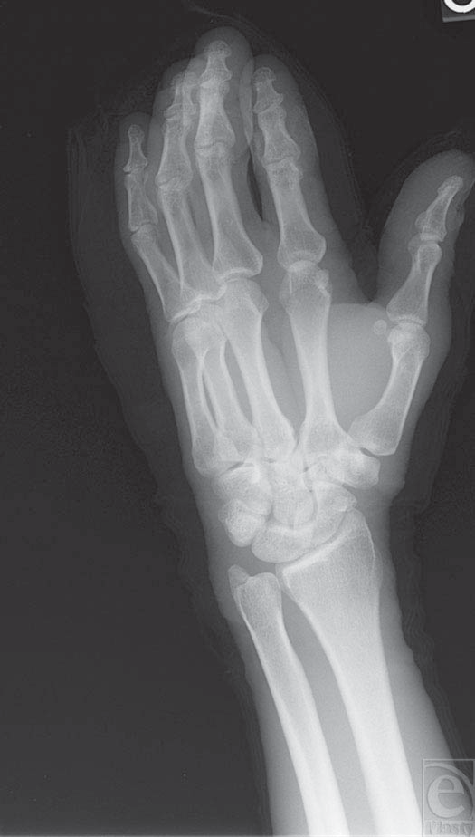 Nail-Gun Injuries to the Hand