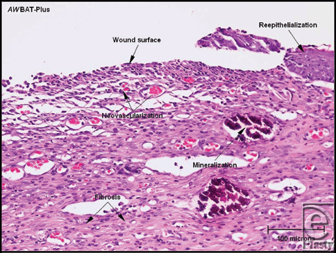Granulation Tissue Histology