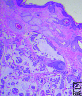 Primary Mucinous Carcinoma of the Skin