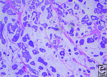 Primary Mucinous Carcinoma of the Skin