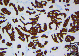 Primary Mucinous Carcinoma of the Skin