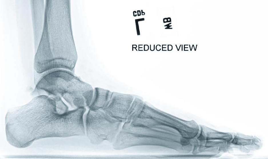 Essential Insights On Imaging For Reconstructive Flatfoot Surgery