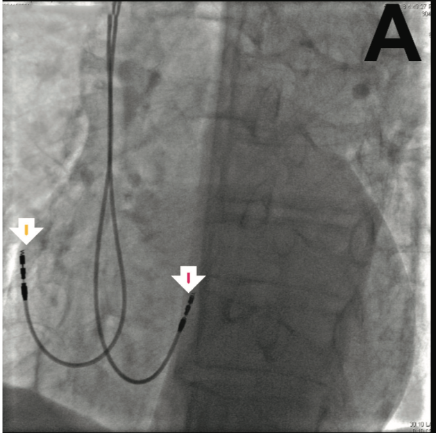 His Bundle Pacing: New Approach Using Stylet-Supported Pacing Leads