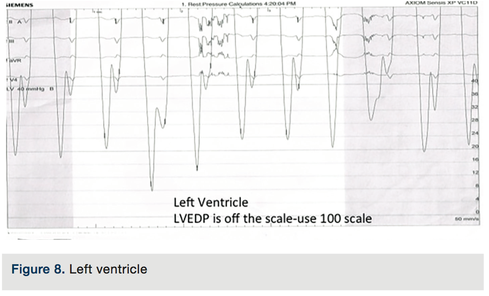 Normal Lvdp Test Your Hemodynamic Knowledge: Part II– The Answer Key