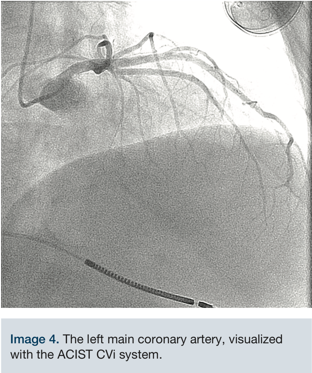 Use of the ACIST CVi System in Structural Heart Interventions ...