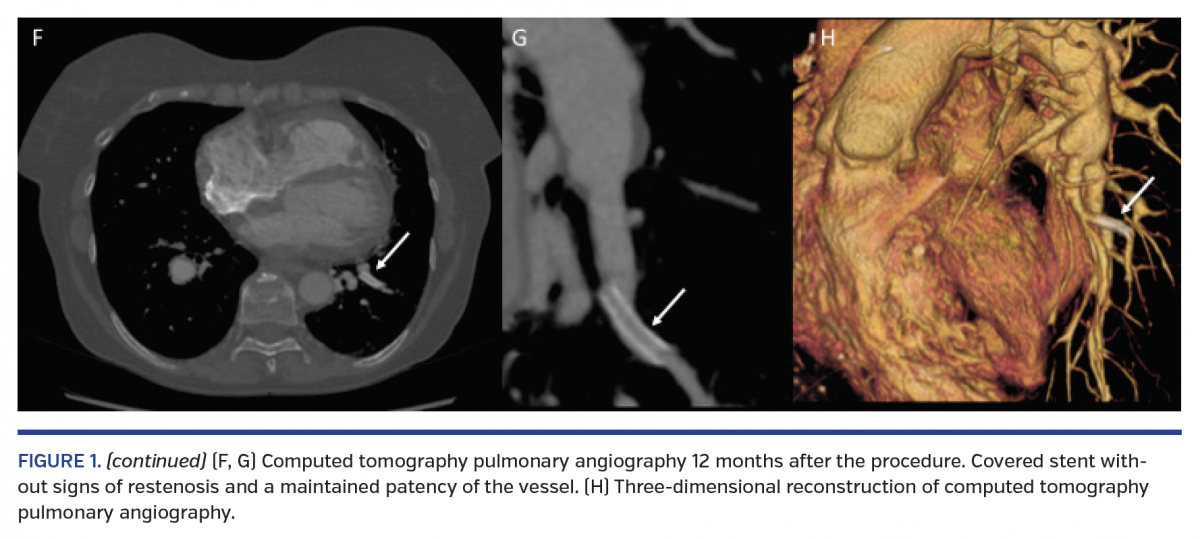 Pulmonary Rupture Rescue Implantation of Covered Stent in Pulmonary Artery Rupture During ...