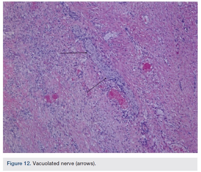 Verve Medical’s Non-Vascular Treatment for Hypertension: A New Target ...