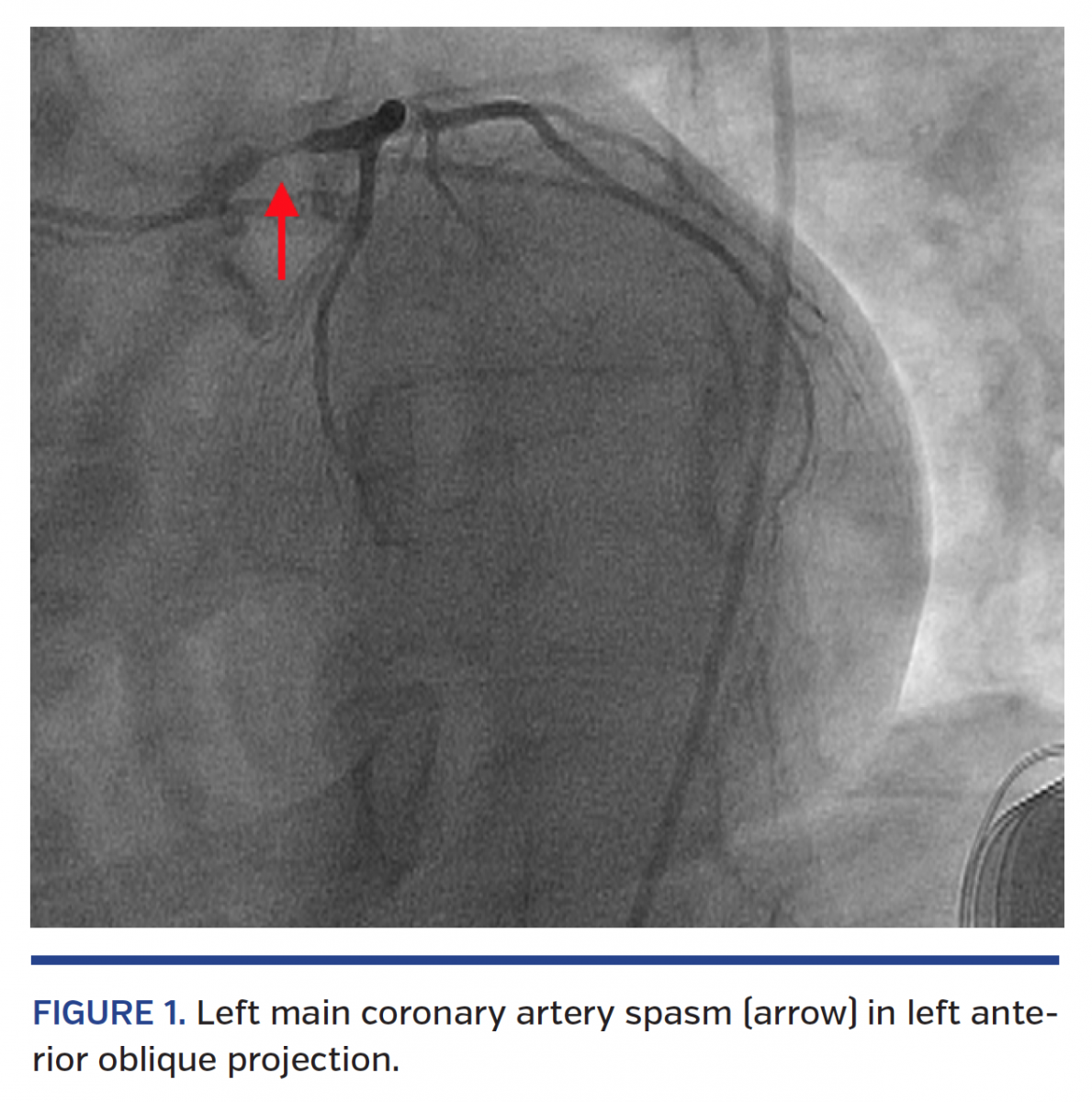 CatheterInduced Coronary Spasm Serious But Preventable