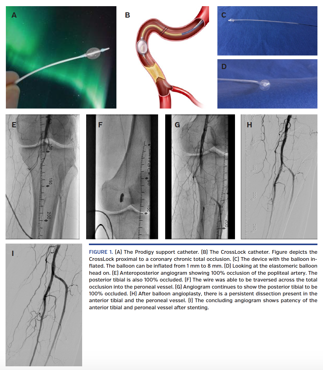 A Step Forward The Use of the CrossLock Catheter in a Patient With