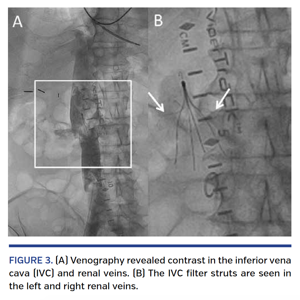 CatheterDirected Fibrinolysis of Submassive Pulmonary Embolism After