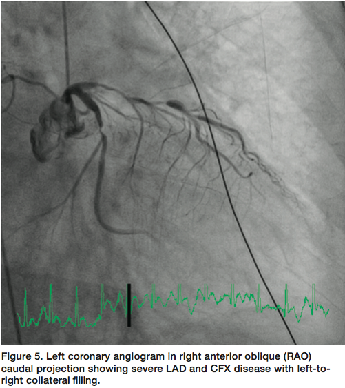 When Do You Decide Not to Take a STEMI Patient to the Cath Lab