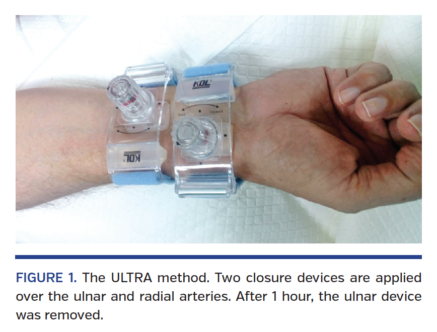ULnar Artery Transient Compression Facilitating Radial Artery Patent