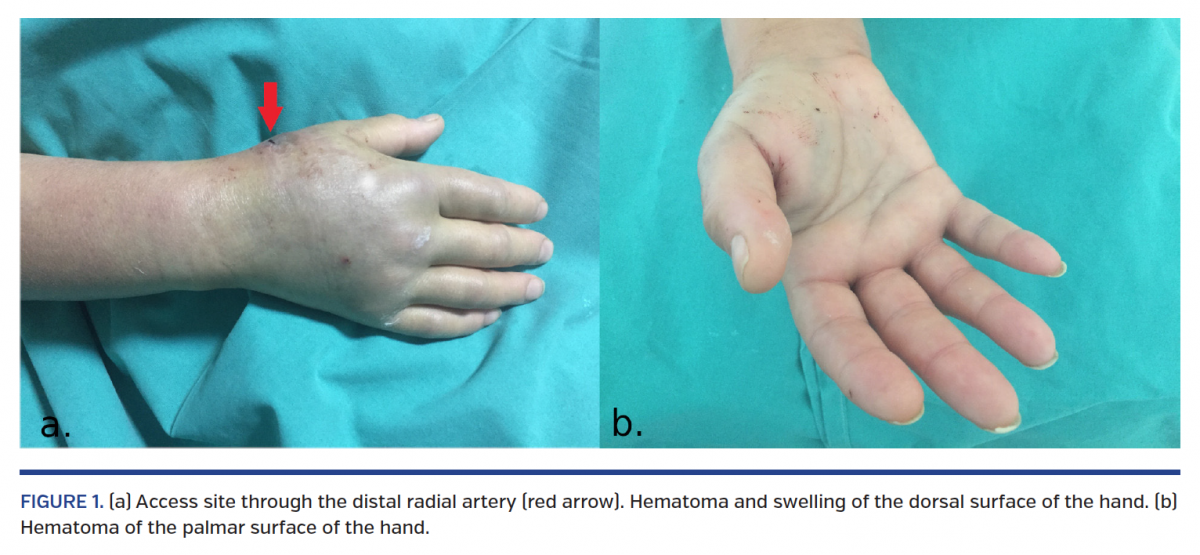 Hand Hematoma After Cardiac Catheterization Via Distal Radial Artery