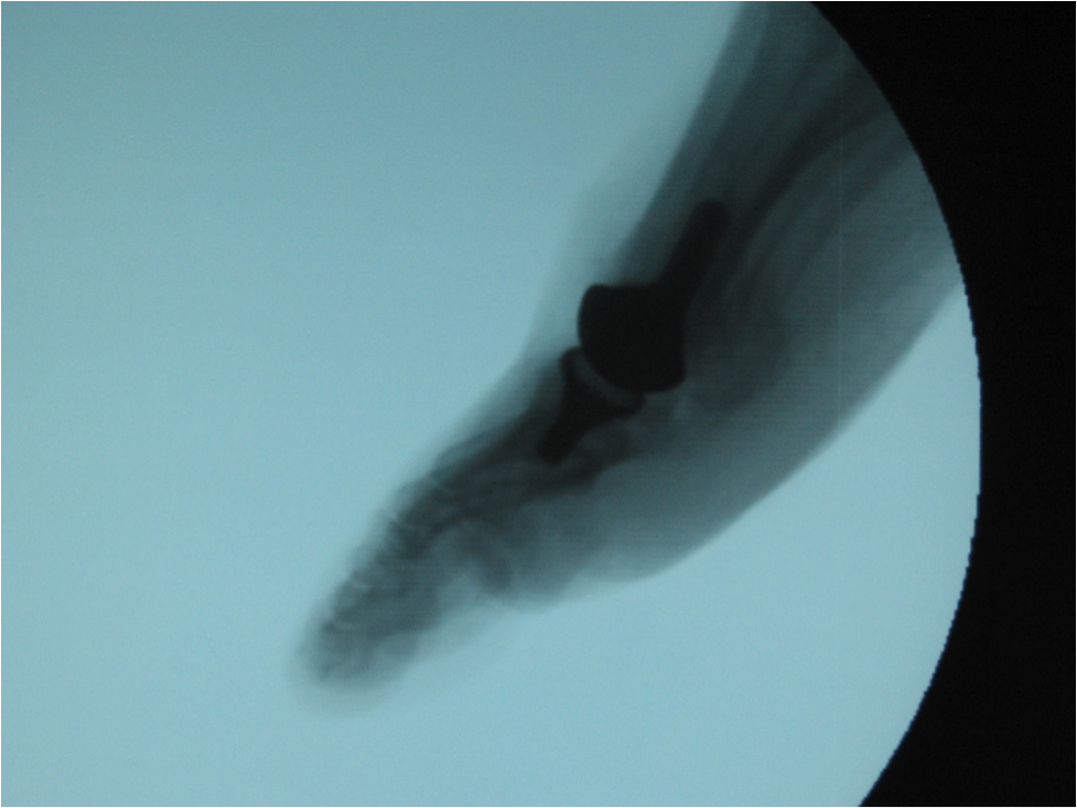 Pertinent Insights On Total Joint Replacement Of The First MPJ