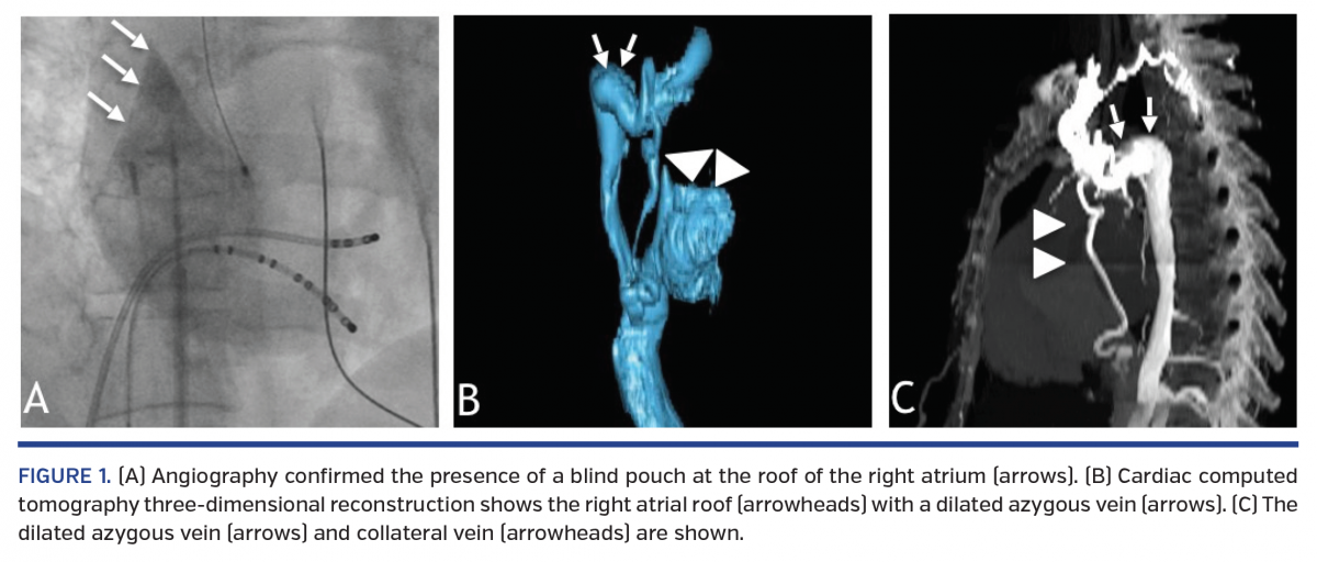 Electrophysiology Study and Catheter Ablation With Superior Vena Cava Stump