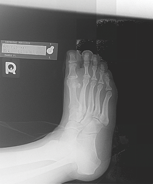 Managing Stress Fractures In Athletes