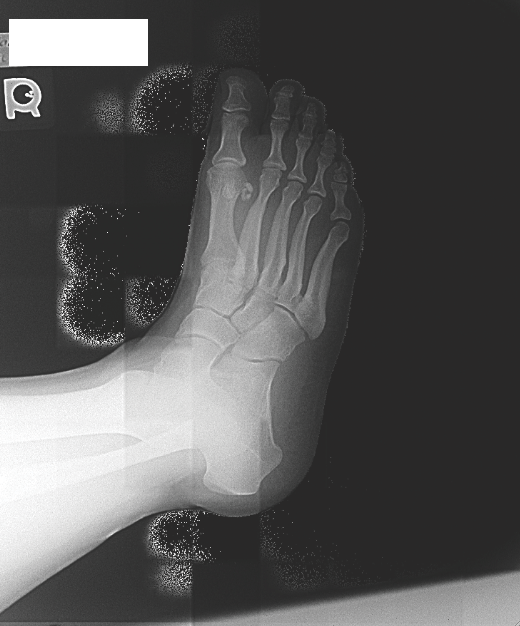 Managing Stress Fractures In Athletes