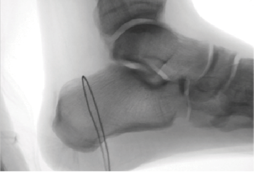 Current Concepts In Surgical Offloading Of The Diabetic Foot