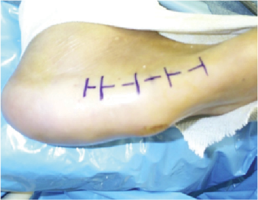 Current Concepts In Surgical Offloading Of The Diabetic Foot