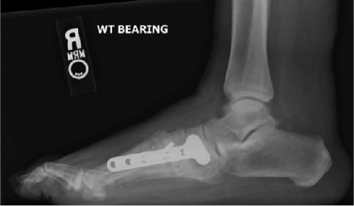 Current Concepts In Surgical Offloading Of The Diabetic Foot