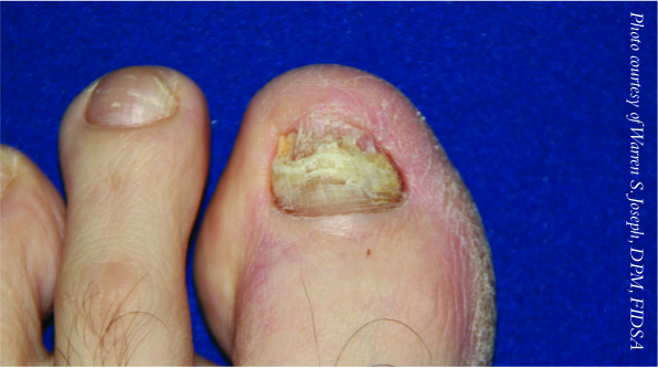 cost of lamisil pills