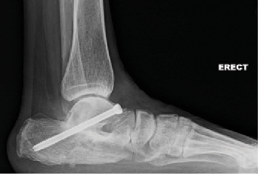 Current Insights In Treating Diabetic Foot And Ankle Trauma