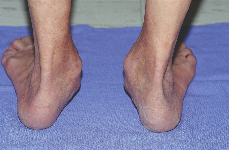A Guide To Orthotic Therapy For AdultAcquired Flatfoot