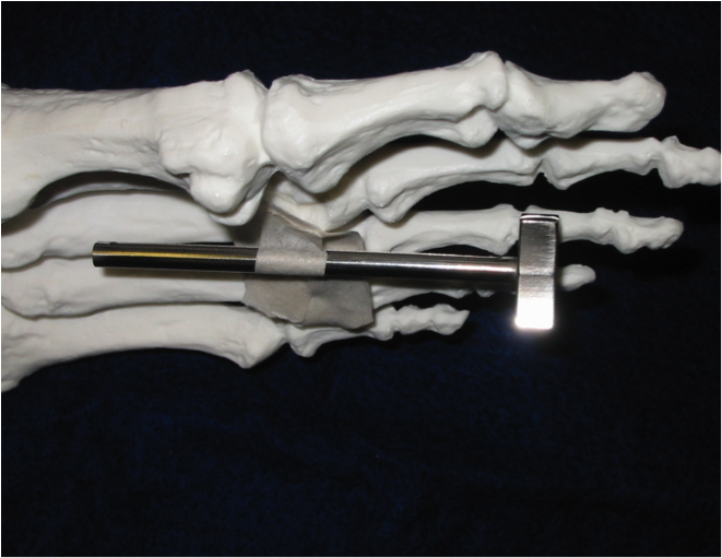 A Guide To Endoscopic For Intermetatarsal Neuromas