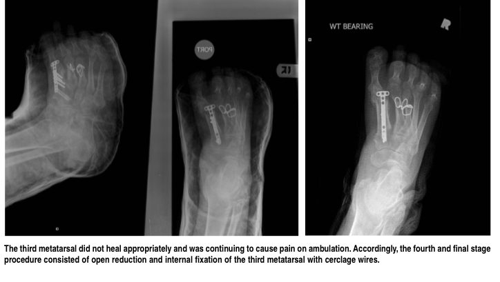 Callus Distraction Of Tfie First Metatarsal – TUYMCH