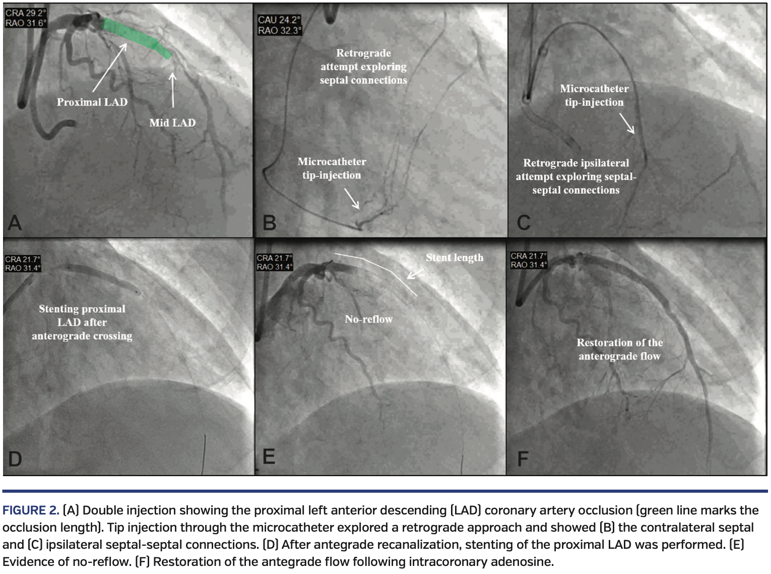 No-Reflow Complicating Chronic Total Occlusion Coronary Revascularization