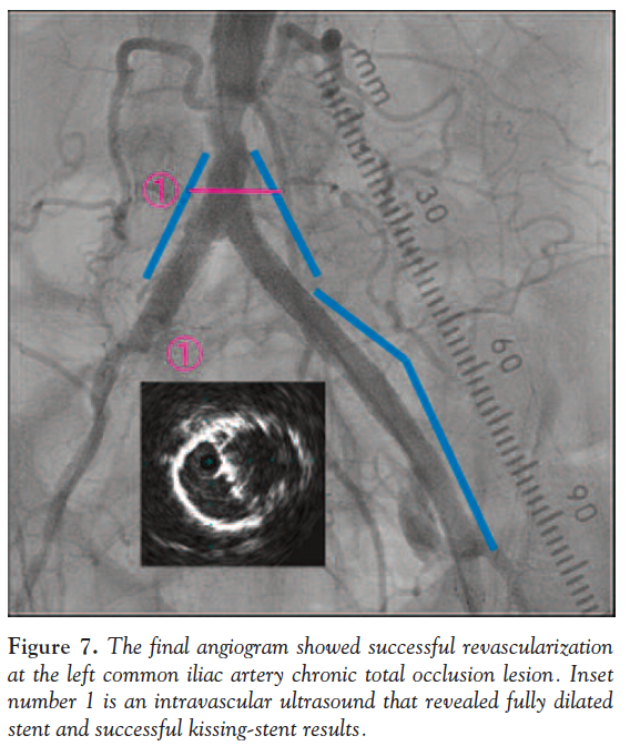 Kissing Iliac Artery Stent Technique for Salvage of a Total Occlusion of a Jailed Common Iliac