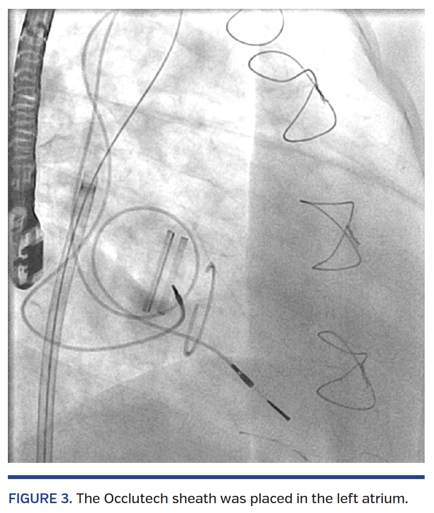 Improved Transseptal Access for Transcatheter Paravalvular Leak Closure ...