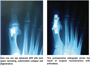 How To Address Avascular Necrosis