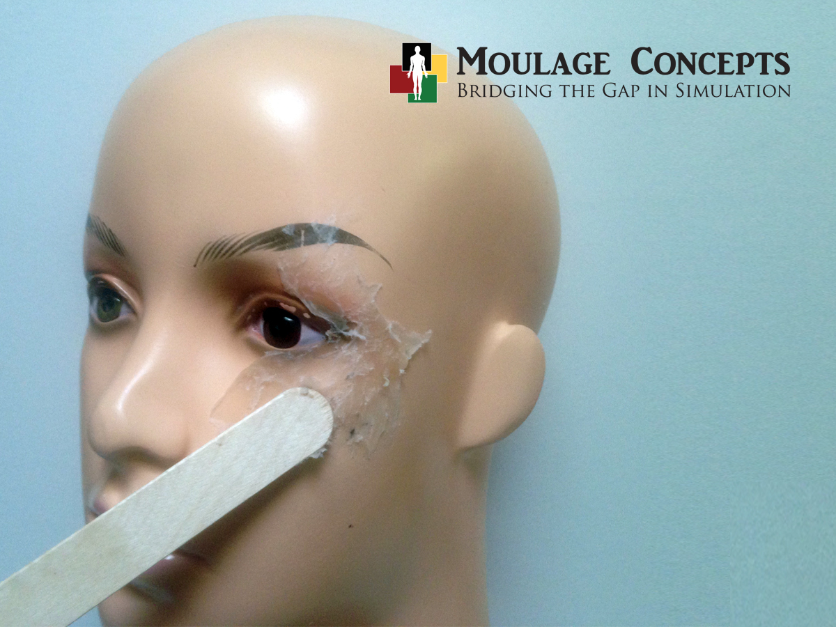 Moulage of the Month Chemical Splash in Eye