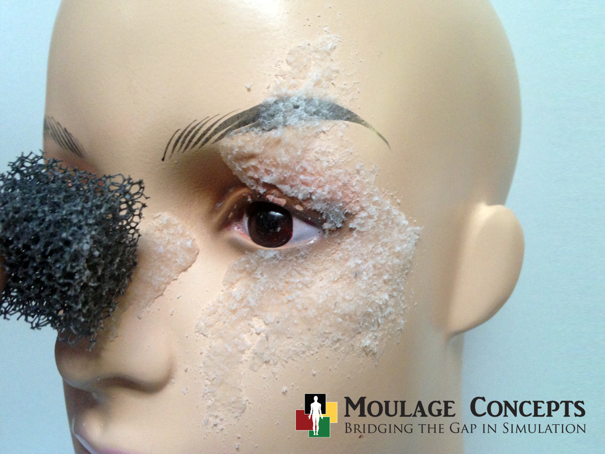 Moulage of the Month: Chemical Splash in Eye
