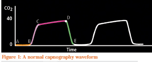 Beyond the Basics: Capnography